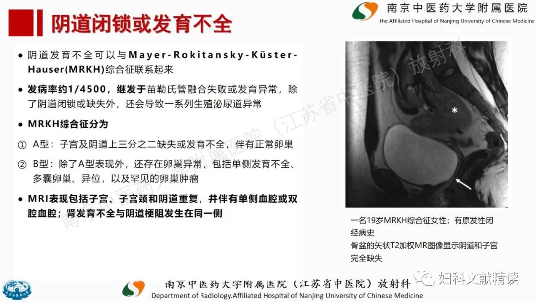 影像PPT - 【PPT】阴道病变影像诊断汇总-15 影像PPT - 【PPT】阴道病变影像诊断汇总-15