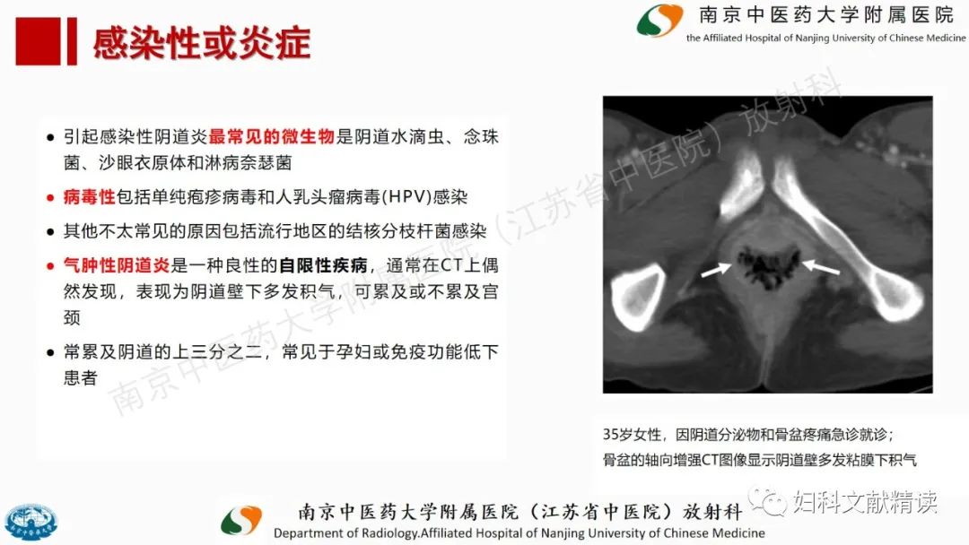 影像PPT - 【PPT】阴道病变影像诊断汇总-21 影像PPT - 【PPT】阴道病变影像诊断汇总-21
