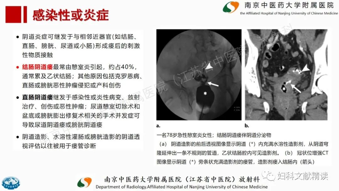 影像PPT - 【PPT】阴道病变影像诊断汇总-22 影像PPT - 【PPT】阴道病变影像诊断汇总-22