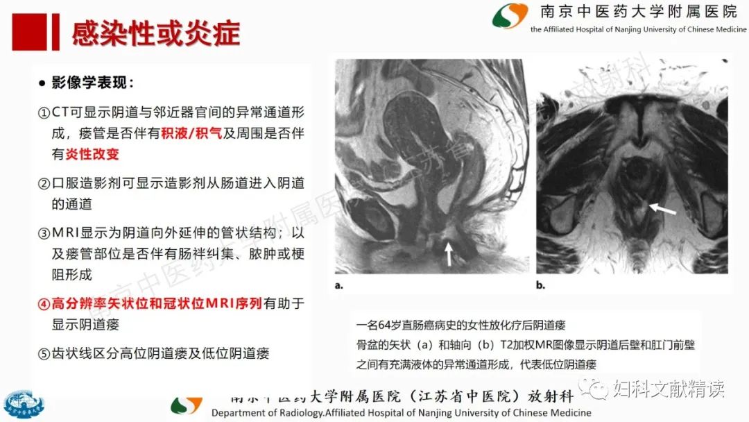 影像PPT - 【PPT】阴道病变影像诊断汇总-23 影像PPT - 【PPT】阴道病变影像诊断汇总-23