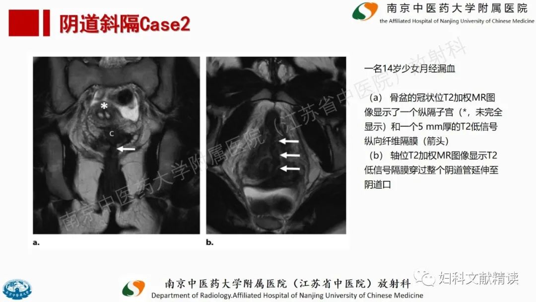 影像PPT - 【PPT】阴道病变影像诊断汇总-20 影像PPT - 【PPT】阴道病变影像诊断汇总-20