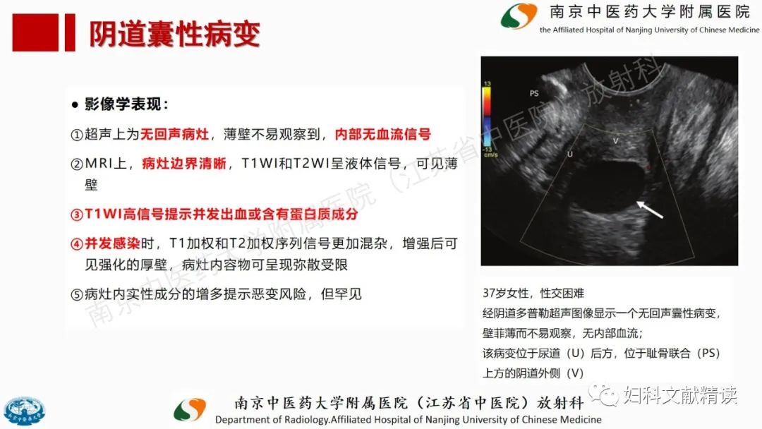 影像PPT - 【PPT】阴道病变影像诊断汇总-25 影像PPT - 【PPT】阴道病变影像诊断汇总-25