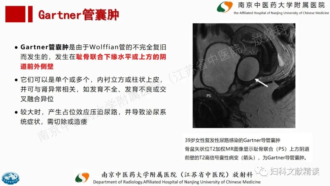影像PPT - 【PPT】阴道病变影像诊断汇总-26 影像PPT - 【PPT】阴道病变影像诊断汇总-26