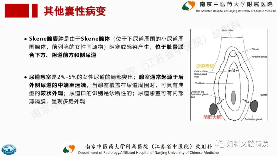 影像PPT - 【PPT】阴道病变影像诊断汇总-29 影像PPT - 【PPT】阴道病变影像诊断汇总-29