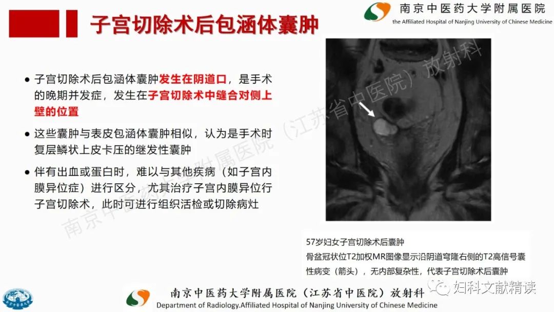 影像PPT - 【PPT】阴道病变影像诊断汇总-27 影像PPT - 【PPT】阴道病变影像诊断汇总-27