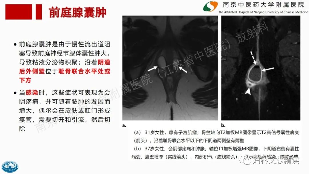影像PPT - 【PPT】阴道病变影像诊断汇总-28 影像PPT - 【PPT】阴道病变影像诊断汇总-28