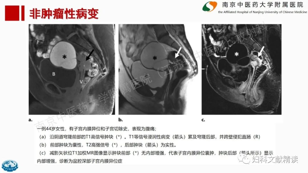 影像PPT - 【PPT】阴道病变影像诊断汇总-32 影像PPT - 【PPT】阴道病变影像诊断汇总-32
