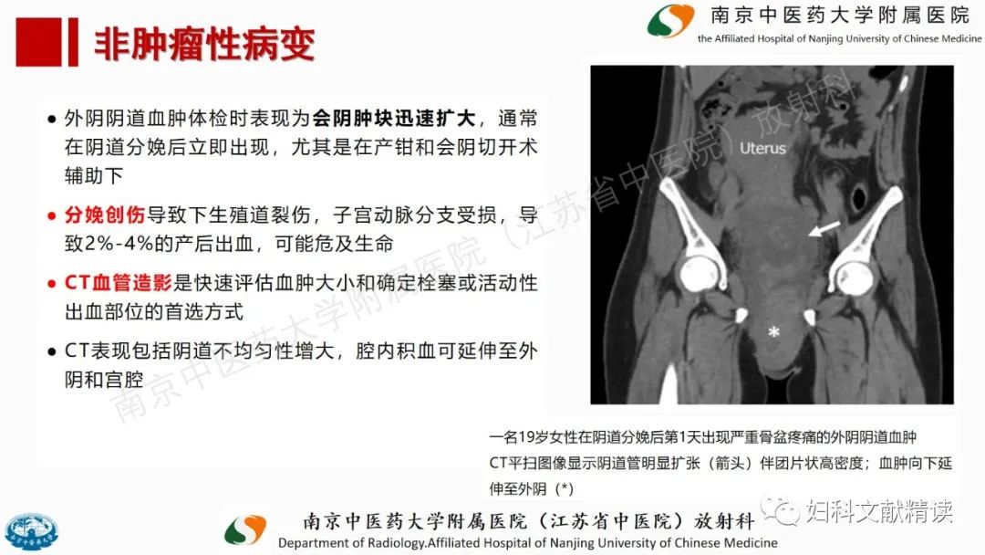 影像PPT - 【PPT】阴道病变影像诊断汇总-33 影像PPT - 【PPT】阴道病变影像诊断汇总-33