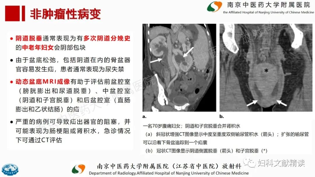 影像PPT - 【PPT】阴道病变影像诊断汇总-34 影像PPT - 【PPT】阴道病变影像诊断汇总-34