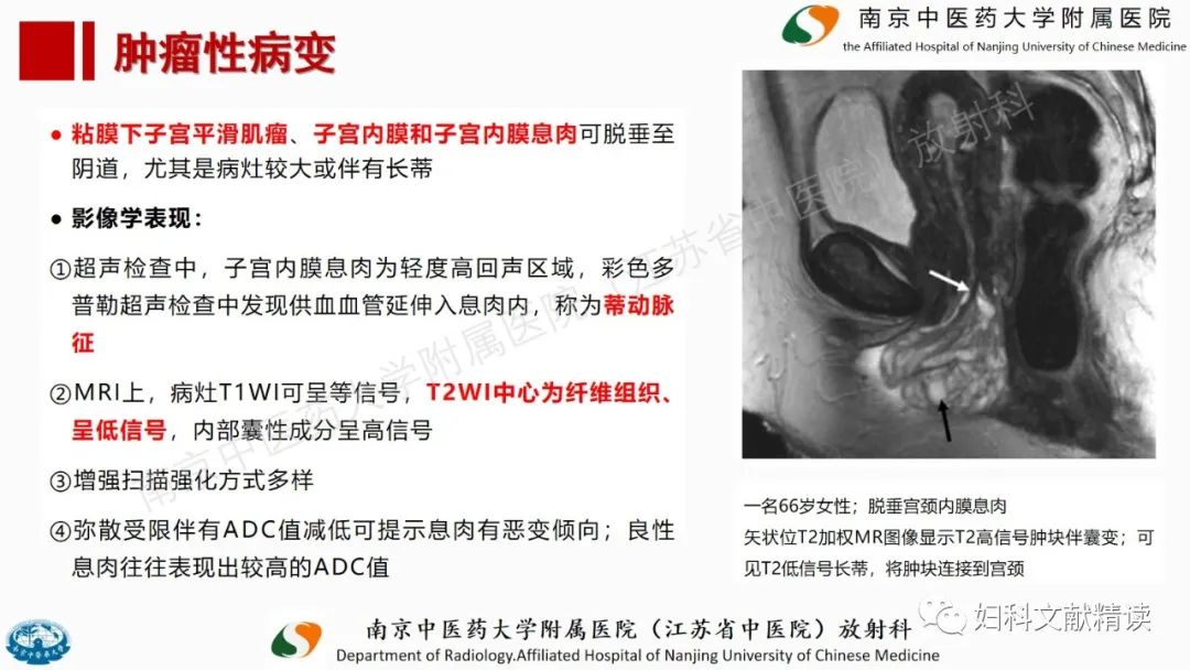影像PPT - 【PPT】阴道病变影像诊断汇总-37 影像PPT - 【PPT】阴道病变影像诊断汇总-37