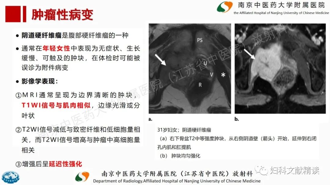 影像PPT - 【PPT】阴道病变影像诊断汇总-38 影像PPT - 【PPT】阴道病变影像诊断汇总-38