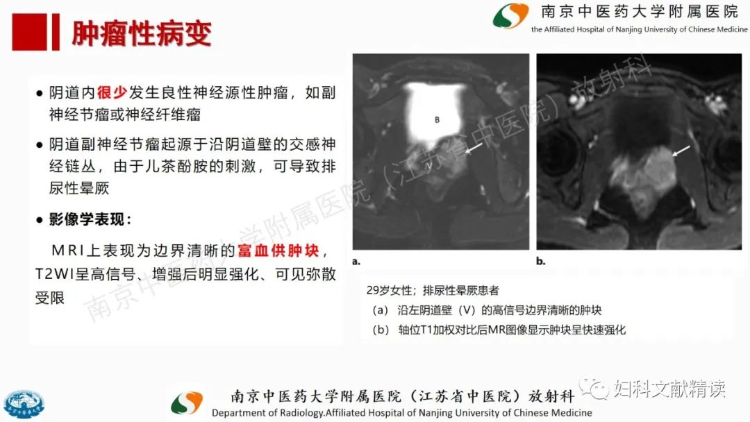 影像PPT - 【PPT】阴道病变影像诊断汇总-39 影像PPT - 【PPT】阴道病变影像诊断汇总-39