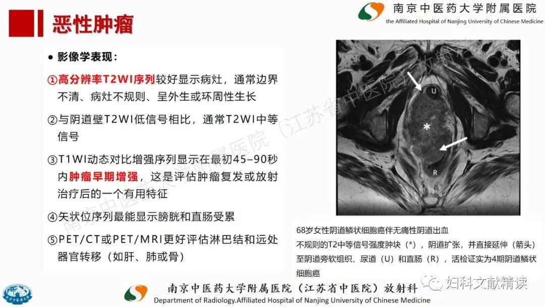 影像PPT - 【PPT】阴道病变影像诊断汇总-42 影像PPT - 【PPT】阴道病变影像诊断汇总-42