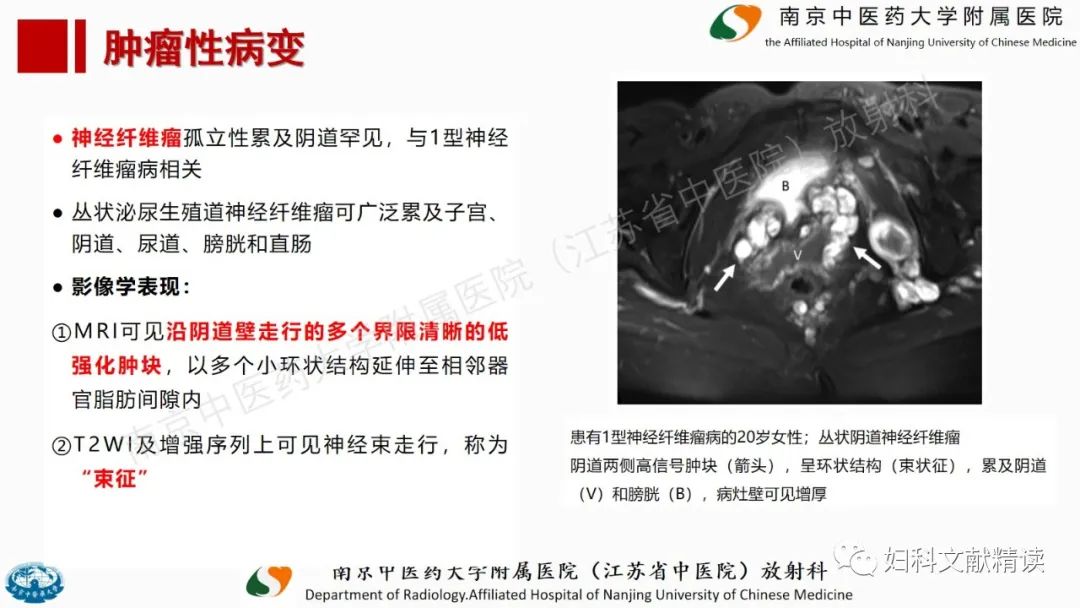 影像PPT - 【PPT】阴道病变影像诊断汇总-40 影像PPT - 【PPT】阴道病变影像诊断汇总-40