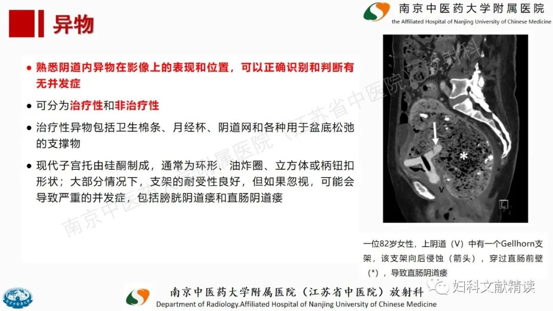 影像PPT - 【PPT】阴道病变影像诊断汇总-45 影像PPT - 【PPT】阴道病变影像诊断汇总-45