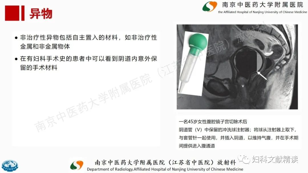 影像PPT - 【PPT】阴道病变影像诊断汇总-46 影像PPT - 【PPT】阴道病变影像诊断汇总-46