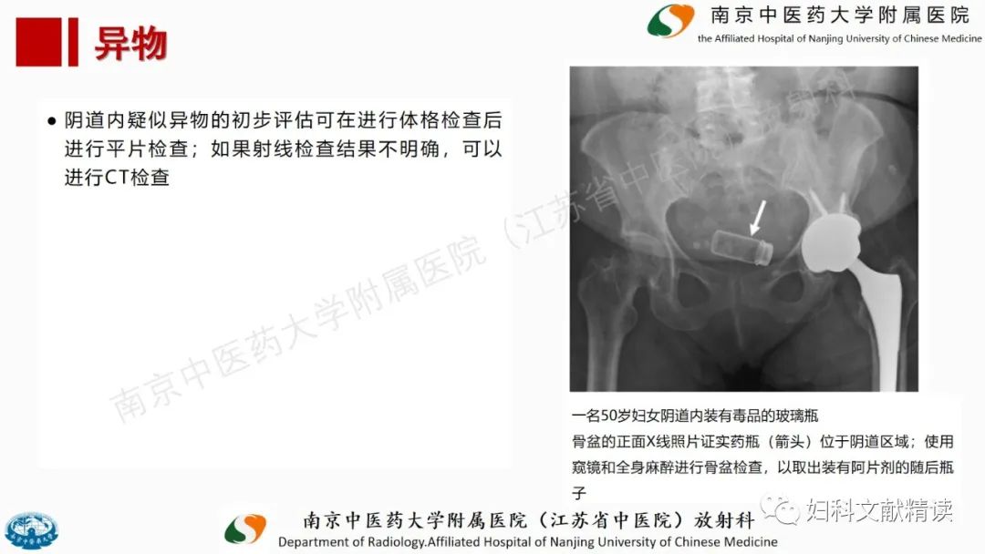 影像PPT - 【PPT】阴道病变影像诊断汇总-47 影像PPT - 【PPT】阴道病变影像诊断汇总-47