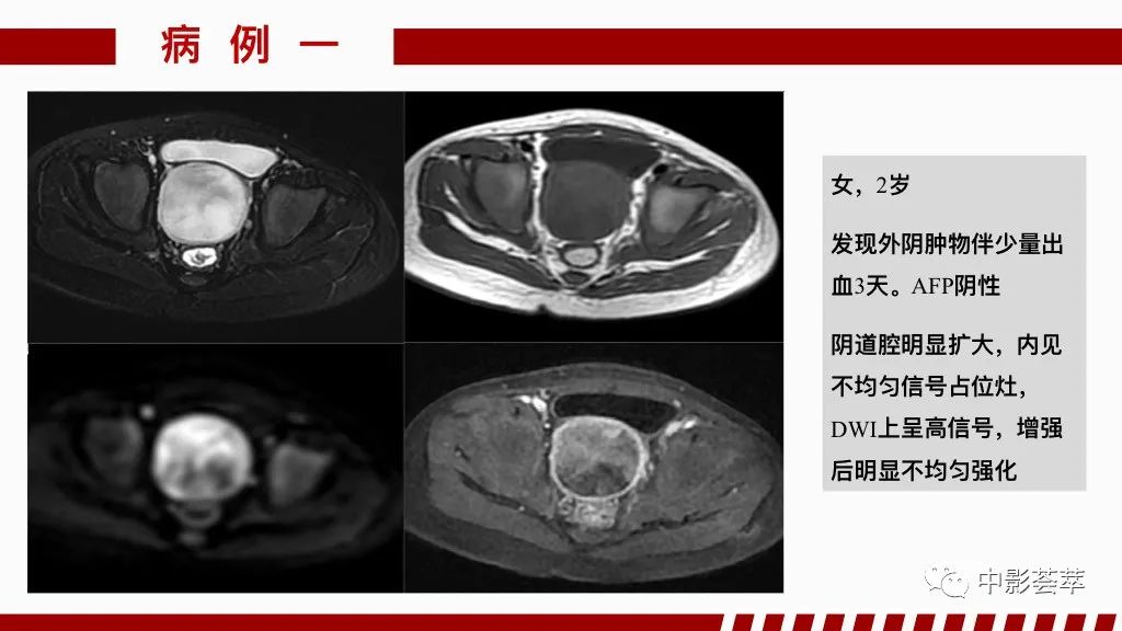 影像PPT - 【PPT】阴道病变影像诊断汇总-59 影像PPT - 【PPT】阴道病变影像诊断汇总-59