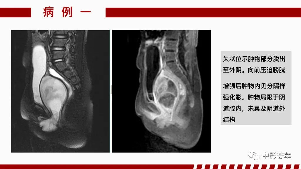 影像PPT - 【PPT】阴道病变影像诊断汇总-60 影像PPT - 【PPT】阴道病变影像诊断汇总-60