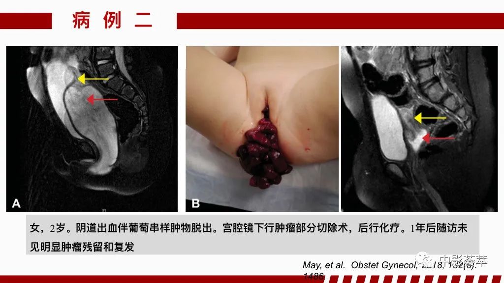 影像PPT - 【PPT】阴道病变影像诊断汇总-61 影像PPT - 【PPT】阴道病变影像诊断汇总-61