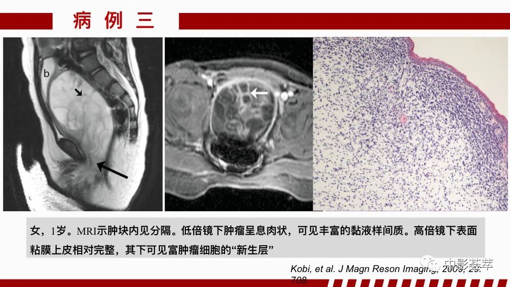 影像PPT - 【PPT】阴道病变影像诊断汇总-62 影像PPT - 【PPT】阴道病变影像诊断汇总-62