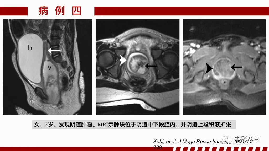 影像PPT - 【PPT】阴道病变影像诊断汇总-63 影像PPT - 【PPT】阴道病变影像诊断汇总-63