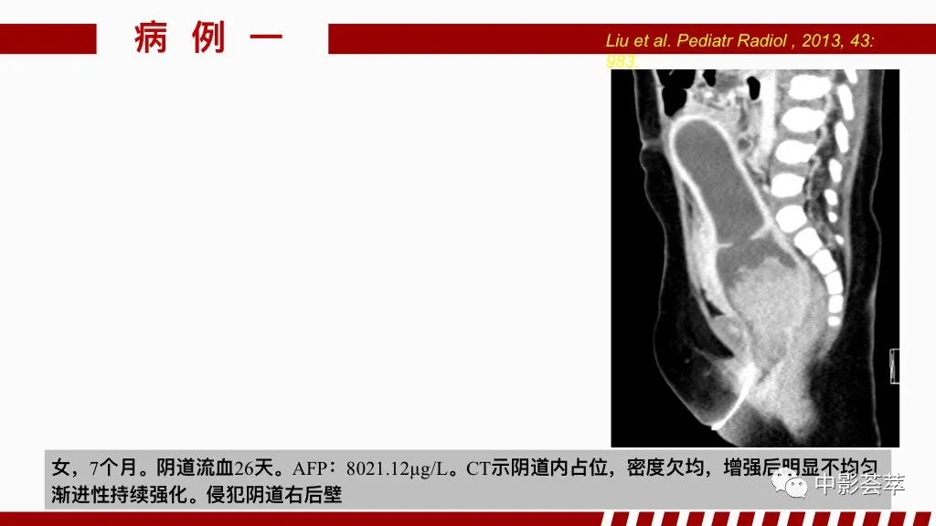 影像PPT - 【PPT】阴道病变影像诊断汇总-65 影像PPT - 【PPT】阴道病变影像诊断汇总-65