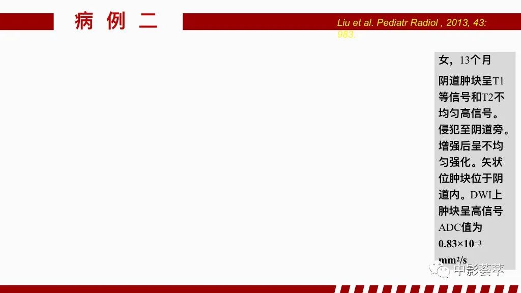 影像PPT - 【PPT】阴道病变影像诊断汇总-66 影像PPT - 【PPT】阴道病变影像诊断汇总-66
