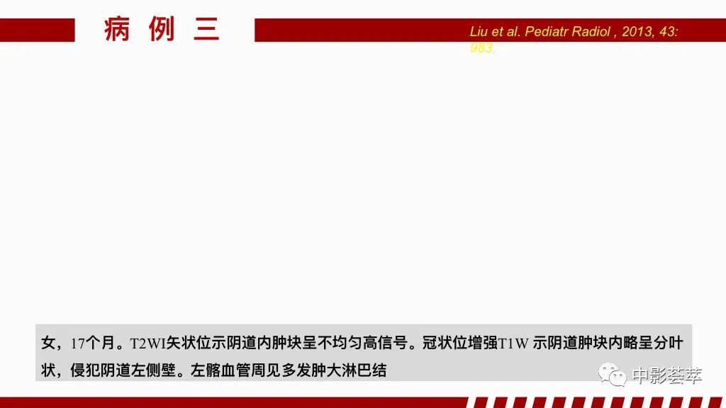 影像PPT - 【PPT】阴道病变影像诊断汇总-67 影像PPT - 【PPT】阴道病变影像诊断汇总-67