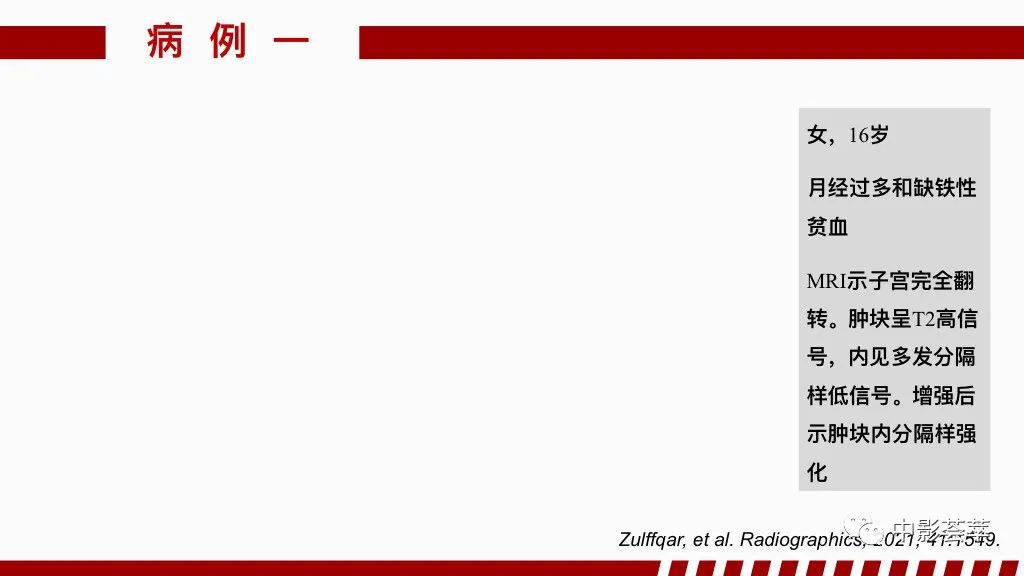 影像PPT - 【PPT】阴道病变影像诊断汇总-71 影像PPT - 【PPT】阴道病变影像诊断汇总-71