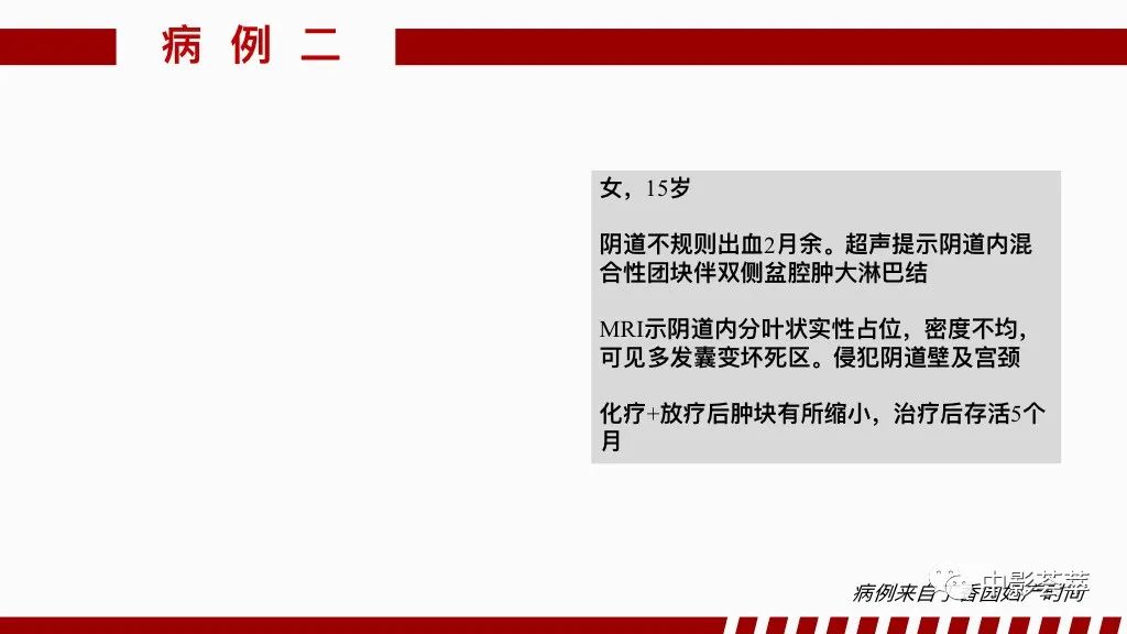 影像PPT - 【PPT】阴道病变影像诊断汇总-72 影像PPT - 【PPT】阴道病变影像诊断汇总-72
