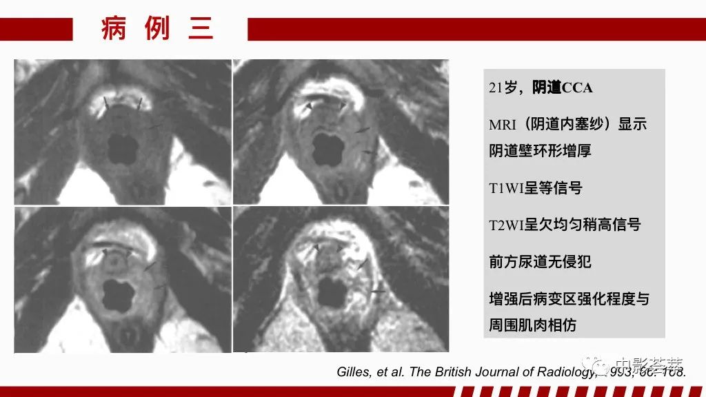 影像PPT - 【PPT】阴道病变影像诊断汇总-76 影像PPT - 【PPT】阴道病变影像诊断汇总-76