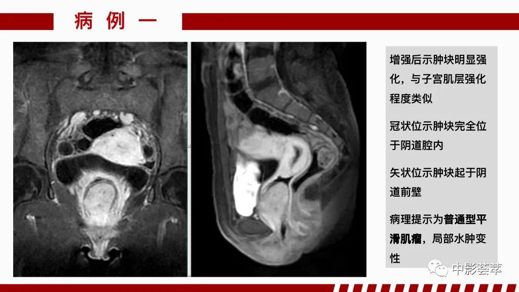 影像PPT - 【PPT】阴道病变影像诊断汇总-80 影像PPT - 【PPT】阴道病变影像诊断汇总-80