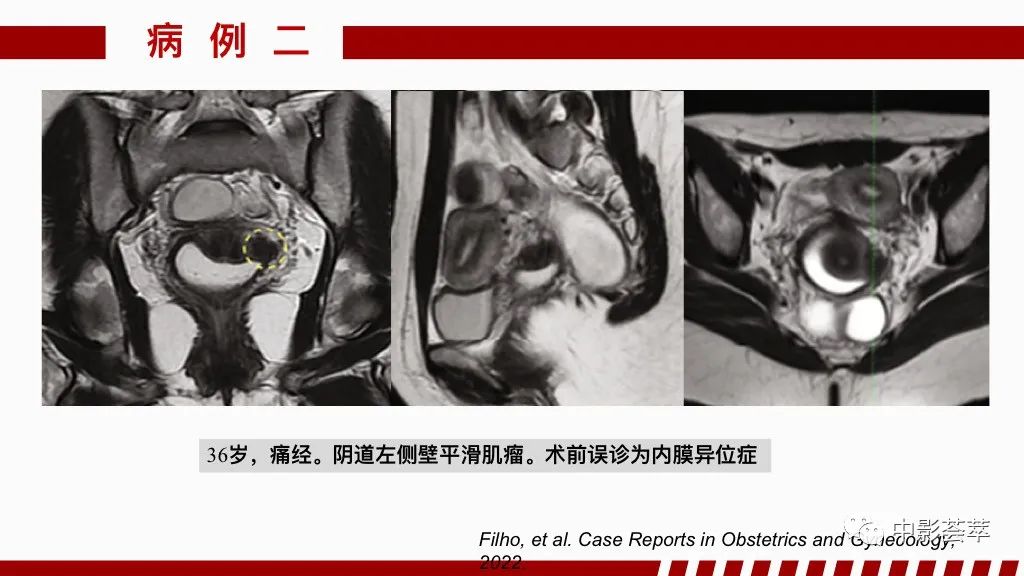 影像PPT - 【PPT】阴道病变影像诊断汇总-81 影像PPT - 【PPT】阴道病变影像诊断汇总-81