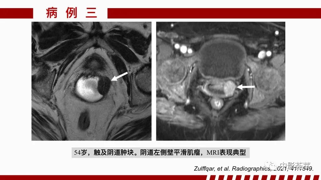 影像PPT - 【PPT】阴道病变影像诊断汇总-82 影像PPT - 【PPT】阴道病变影像诊断汇总-82