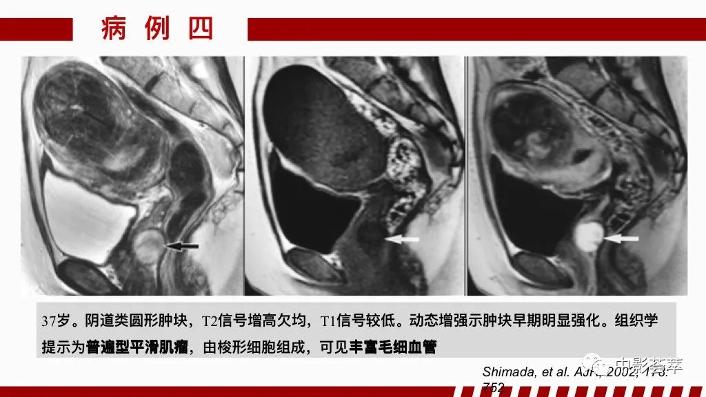 影像PPT - 【PPT】阴道病变影像诊断汇总-83 影像PPT - 【PPT】阴道病变影像诊断汇总-83