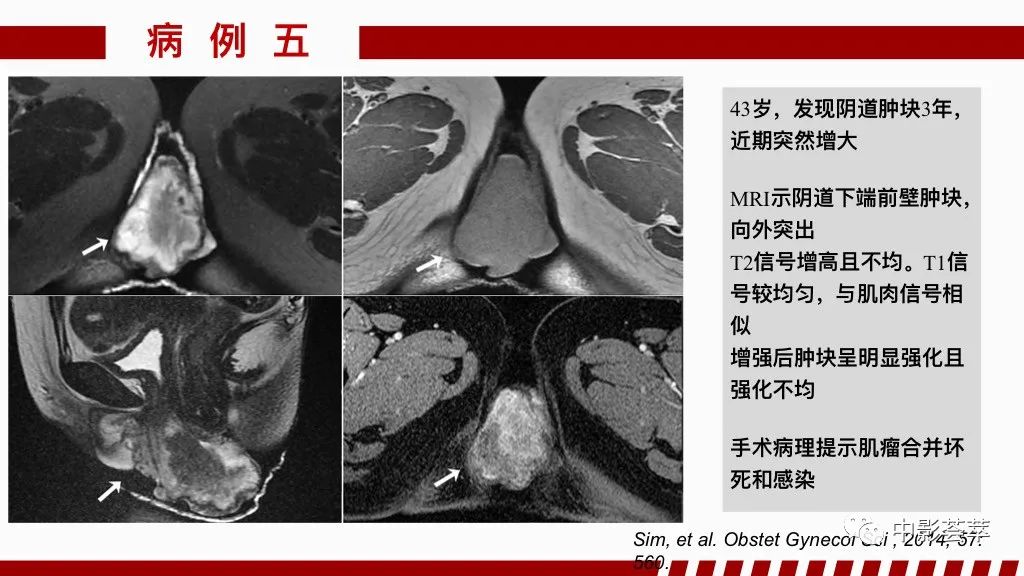 影像PPT - 【PPT】阴道病变影像诊断汇总-84 影像PPT - 【PPT】阴道病变影像诊断汇总-84