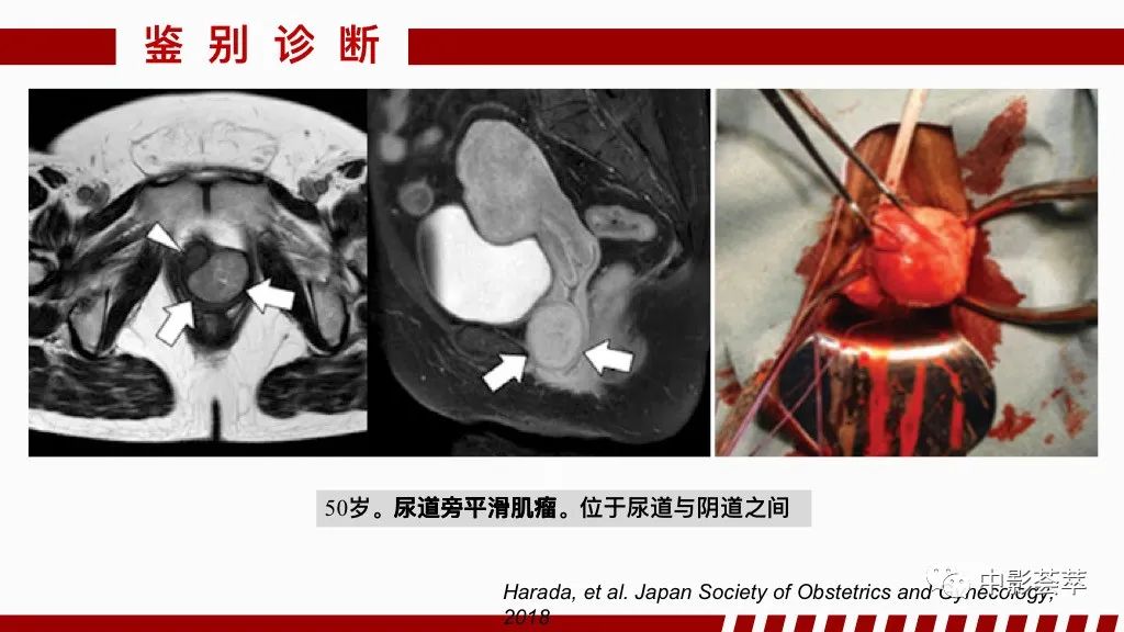 影像PPT - 【PPT】阴道病变影像诊断汇总-85 影像PPT - 【PPT】阴道病变影像诊断汇总-85