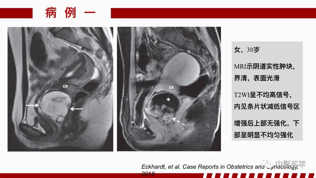 影像PPT - 【PPT】阴道病变影像诊断汇总-88 影像PPT - 【PPT】阴道病变影像诊断汇总-88
