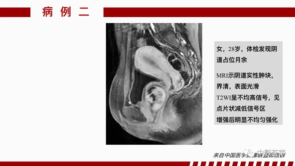 影像PPT - 【PPT】阴道病变影像诊断汇总-90 影像PPT - 【PPT】阴道病变影像诊断汇总-90