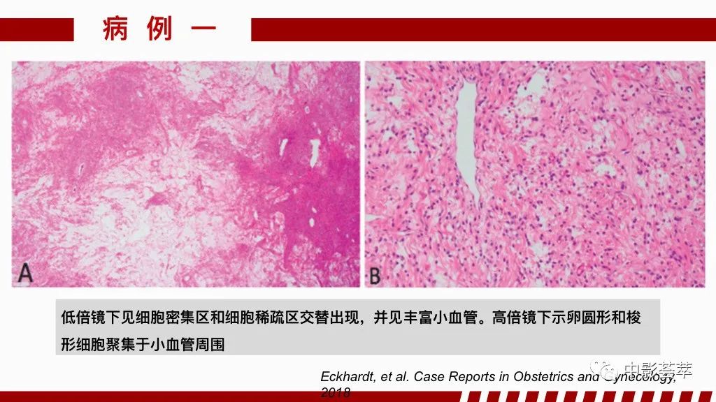 影像PPT - 【PPT】阴道病变影像诊断汇总-89 影像PPT - 【PPT】阴道病变影像诊断汇总-89