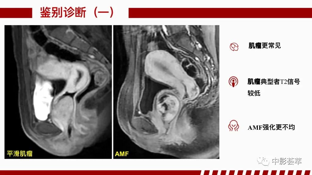影像PPT - 【PPT】阴道病变影像诊断汇总-91 影像PPT - 【PPT】阴道病变影像诊断汇总-91