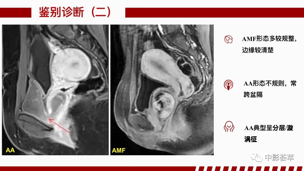 影像PPT - 【PPT】阴道病变影像诊断汇总-92 影像PPT - 【PPT】阴道病变影像诊断汇总-92