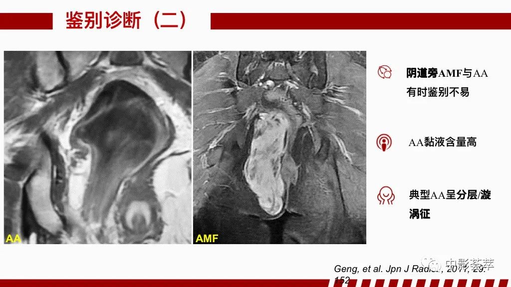 影像PPT - 【PPT】阴道病变影像诊断汇总-93 影像PPT - 【PPT】阴道病变影像诊断汇总-93