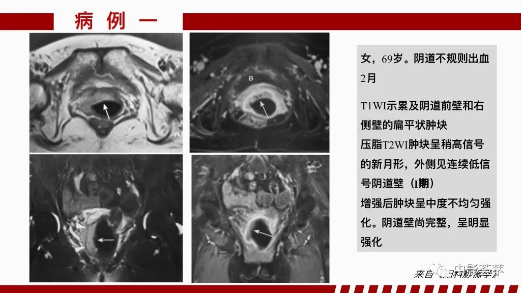影像PPT - 【PPT】阴道病变影像诊断汇总-95 影像PPT - 【PPT】阴道病变影像诊断汇总-95