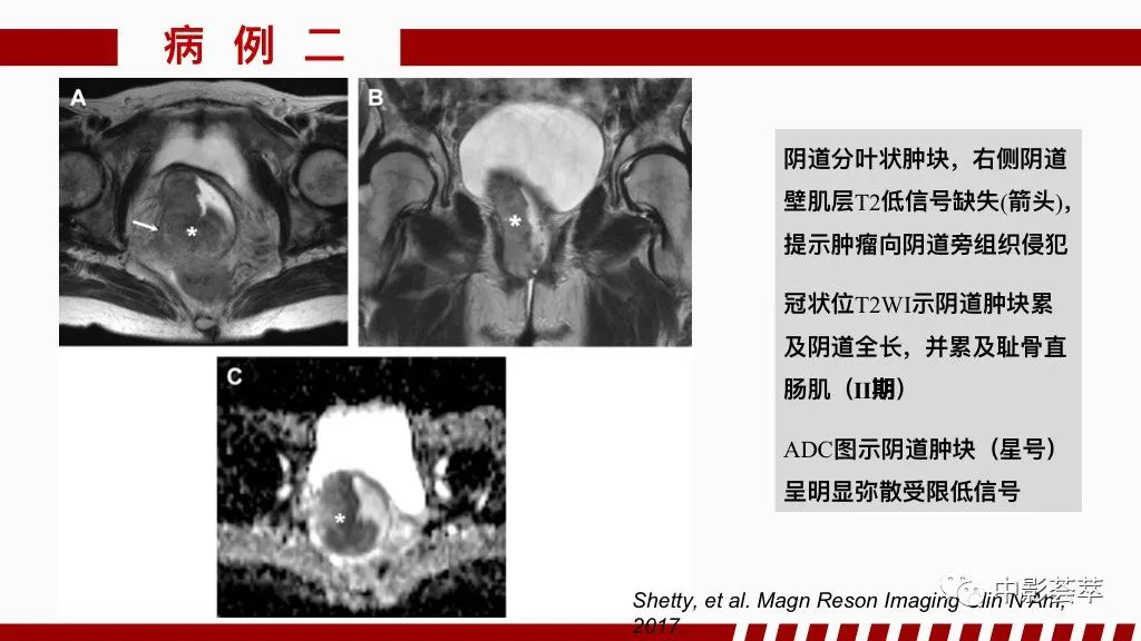 影像PPT - 【PPT】阴道病变影像诊断汇总-96 影像PPT - 【PPT】阴道病变影像诊断汇总-96