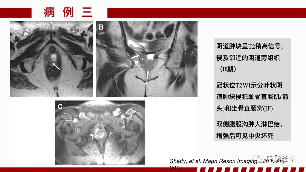 影像PPT - 【PPT】阴道病变影像诊断汇总-97 影像PPT - 【PPT】阴道病变影像诊断汇总-97