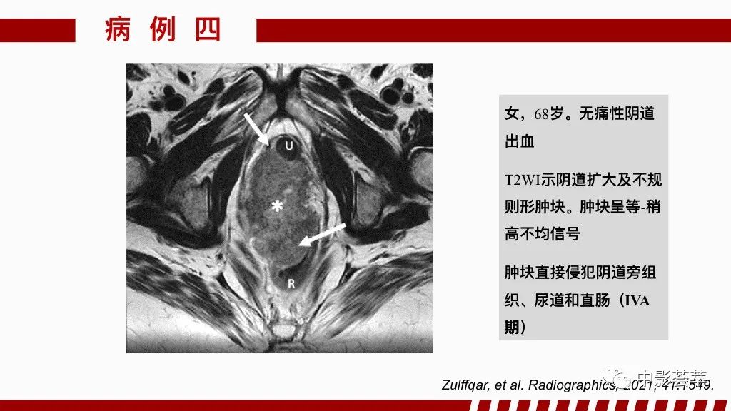 影像PPT - 【PPT】阴道病变影像诊断汇总-98 影像PPT - 【PPT】阴道病变影像诊断汇总-98