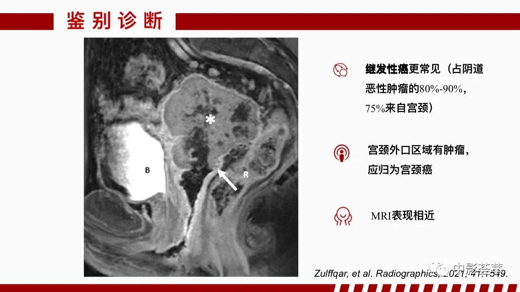影像PPT - 【PPT】阴道病变影像诊断汇总-99 影像PPT - 【PPT】阴道病变影像诊断汇总-99