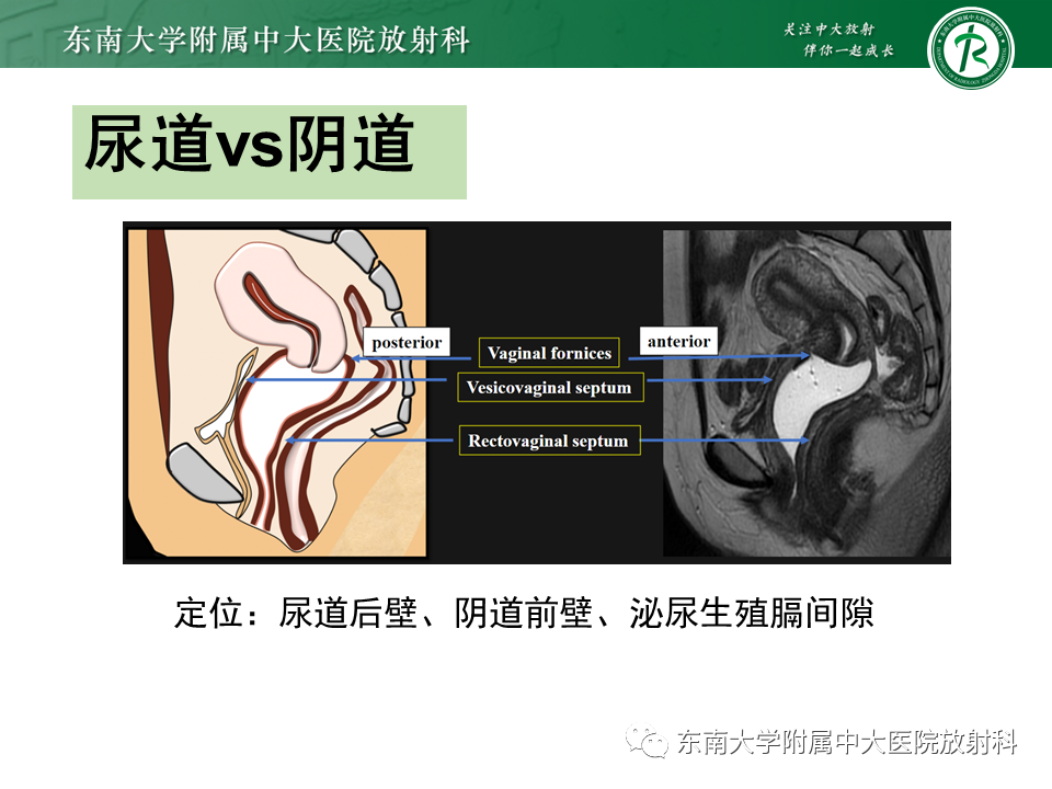 影像PPT - 【PPT】阴道病变影像诊断汇总-109 影像PPT - 【PPT】阴道病变影像诊断汇总-109